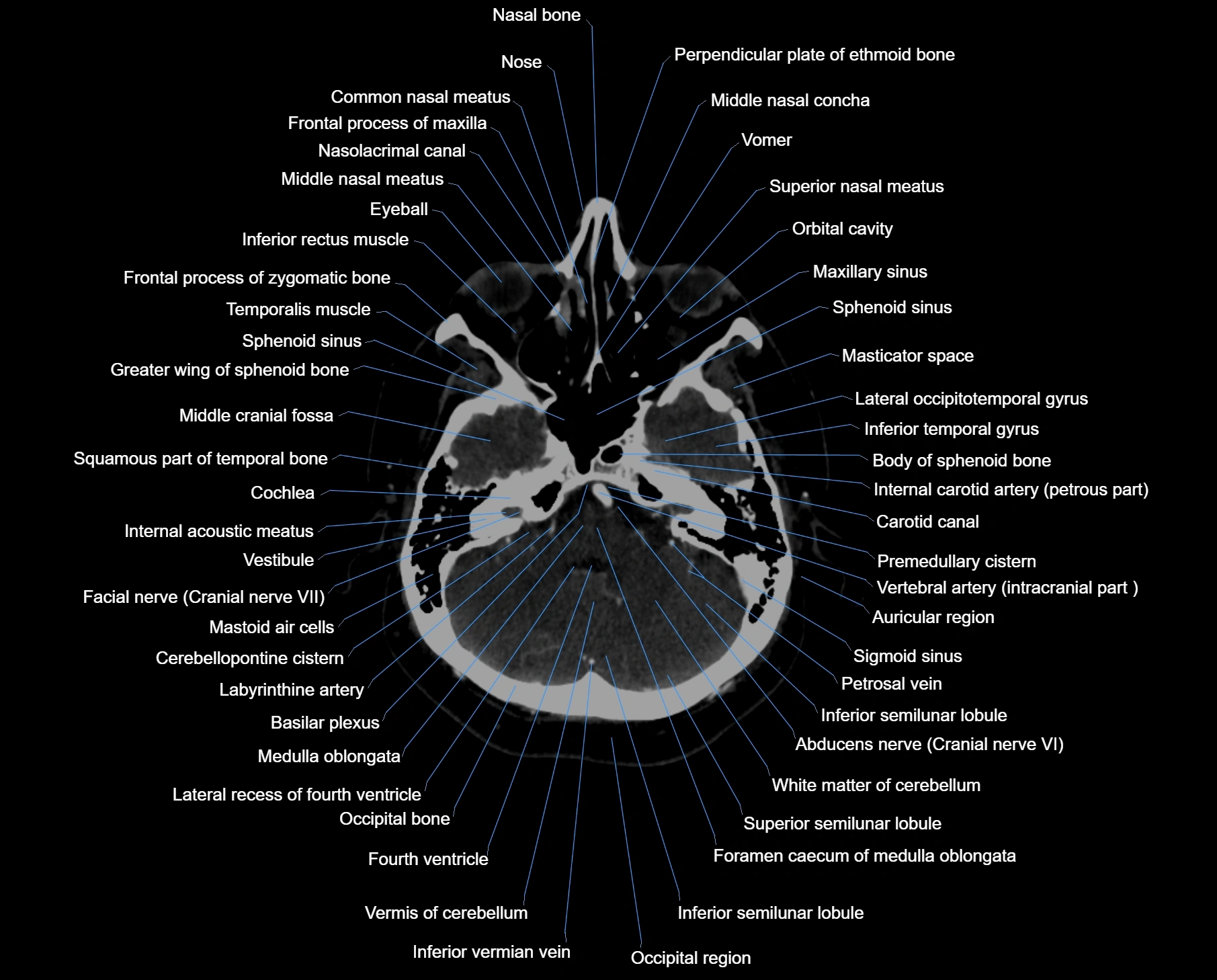 CT scan brain axial labelled cross sectional anatomy image-img-000016.webp